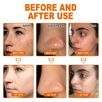 ✨2 kaufen+2 gratis✨Kräuter-Anti-Akne-Peel-Off-Maske